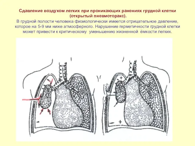 Сдавление воздухом легких при проникающих ранениях грудной клетки (открытый пневмоторакс). В