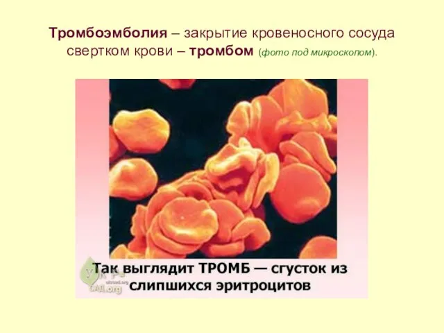 Тромбоэмболия – закрытие кровеносного сосуда свертком крови – тромбом (фото под микроскопом).