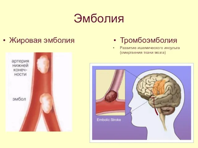 Эмболия Жировая эмболия Тромбоэмболия Развитие ишемического инсульта (омертвения ткани мозга)