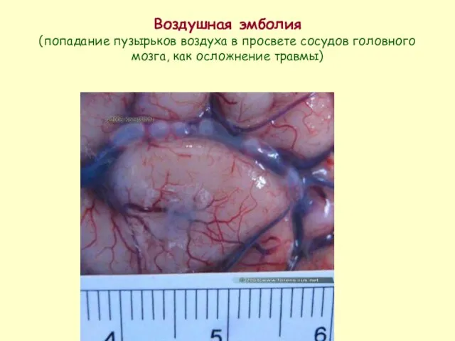 Воздушная эмболия (попадание пузырьков воздуха в просвете сосудов головного мозга, как осложнение травмы)