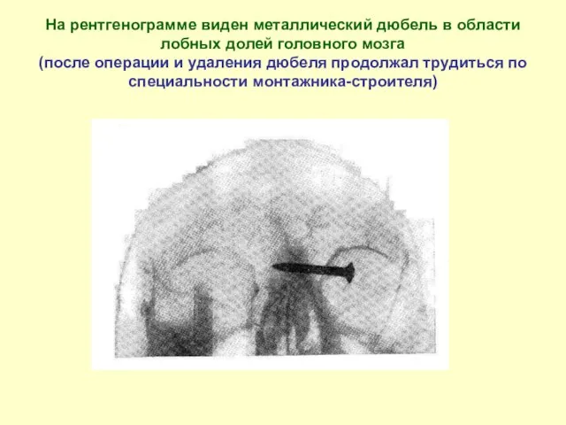 На рентгенограмме виден металлический дюбель в области лобных долей головного мозга