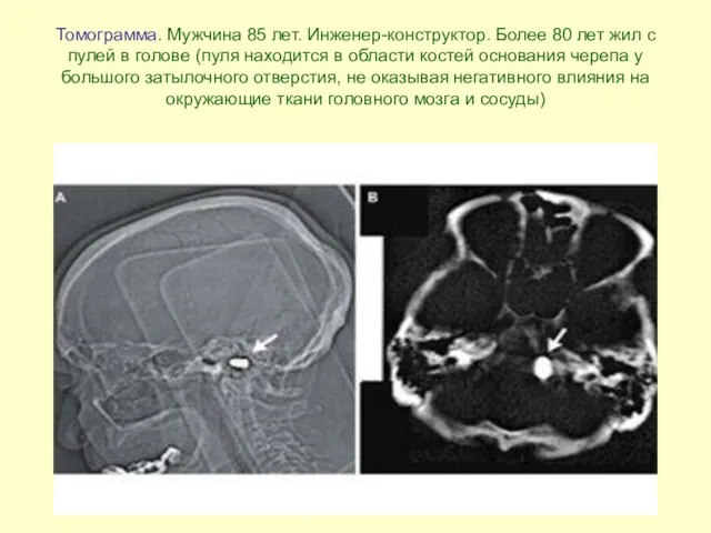 Томограмма. Мужчина 85 лет. Инженер-конструктор. Более 80 лет жил с пулей