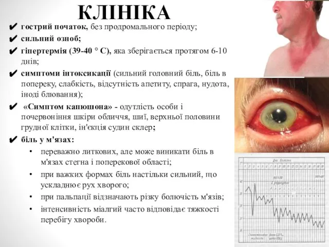 КЛІНІКА гострий початок, без продромального періоду; сильний озноб; гіпертермія (39-40 °