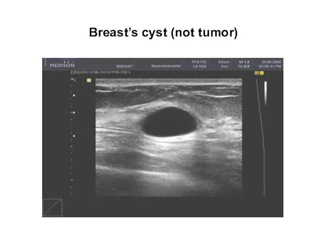 Breast’s cyst (not tumor)