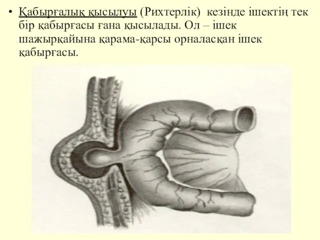 Қабырғалық қысылуы (Рихтерлiк) кезiнде iшектiң тек бiр қабырғасы ғана қысылады. Ол