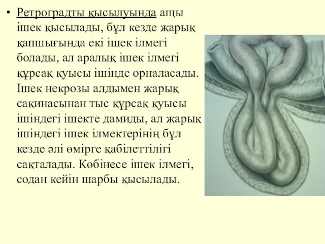 Ретроградты қысылуында ащы iшек қысылады, бұл кезде жарық қапшығында екi iшек