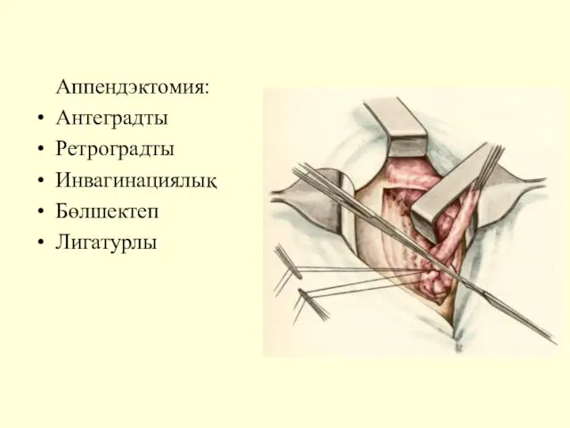 Аппендэктомия: Антеградты Ретроградты Инвагинациялық Бөлшектеп Лигатурлы