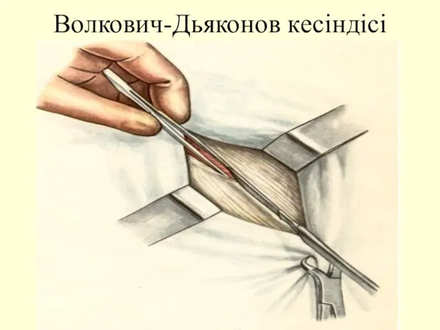 Волкович-Дьяконов кесіндісі