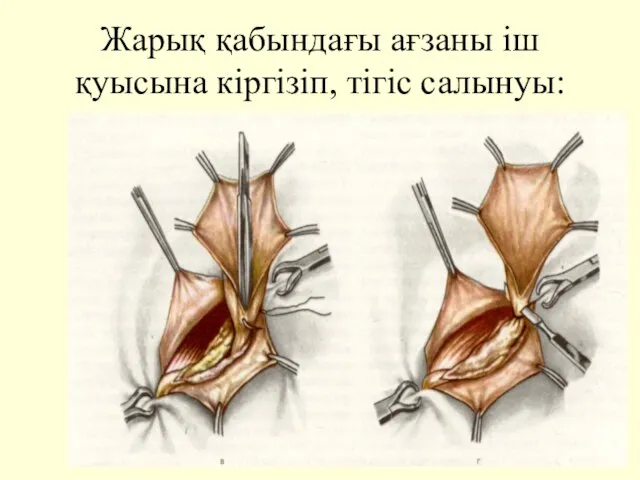 Жарық қабындағы ағзаны іш қуысына кіргізіп, тігіс салынуы: