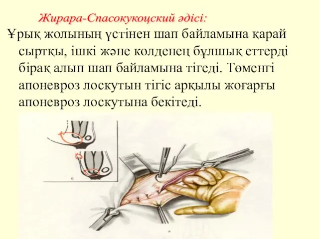 Ұрық жолының үстінен шап байламына қарай сыртқы, ішкі және көлденең бұлшық