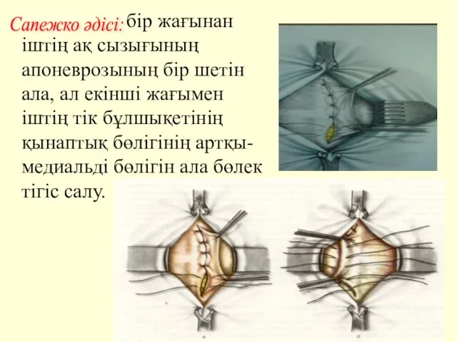 бір жағынан іштің ақ сызығының апоневрозының бір шетін ала, ал екінші