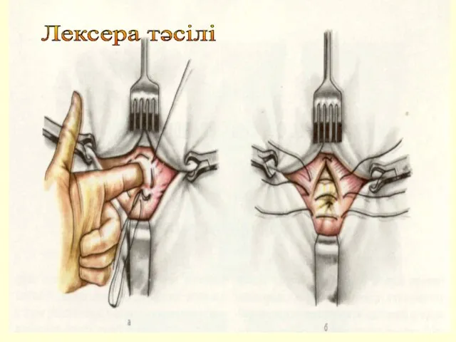 Лексера тәсілі