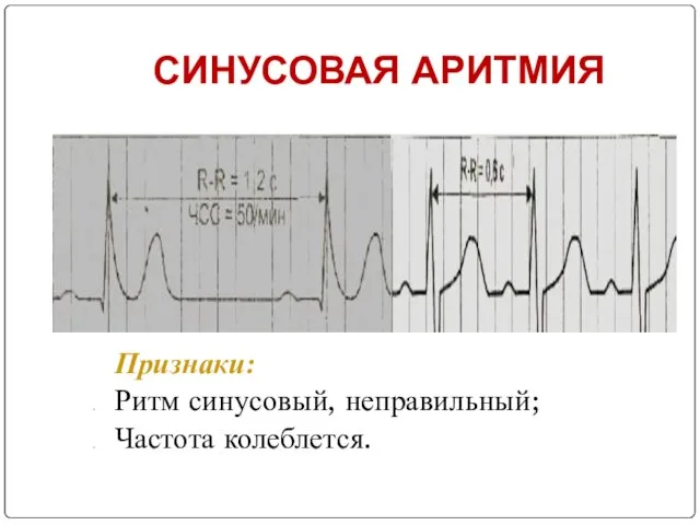 СИНУСОВАЯ АРИТМИЯ Признаки: Ритм синусовый, неправильный; Частота колеблется.