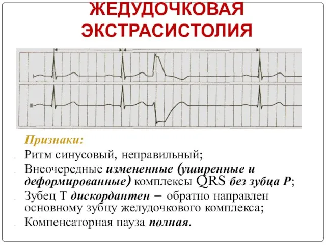 ЖЕДУДОЧКОВАЯ ЭКСТРАСИСТОЛИЯ Признаки: Ритм синусовый, неправильный; Внеочередные измененные (уширенные и деформированные)