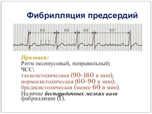 Фибрилляция предсердий Признаки: Ритм несинусовый, неправильный; ЧСС: тахисистолическая (90-160 в мин);
