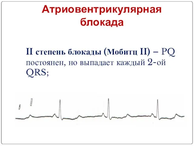 Атриовентрикулярная блокада II степень блокады (Мобитц II) – PQ постоянен, но выпадает каждый 2-ой QRS;