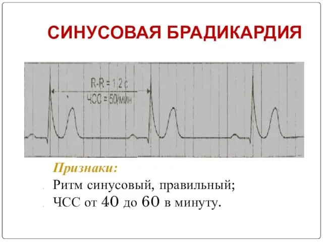 СИНУСОВАЯ БРАДИКАРДИЯ Признаки: Ритм синусовый, правильный; ЧСС от 40 до 60 в минуту.