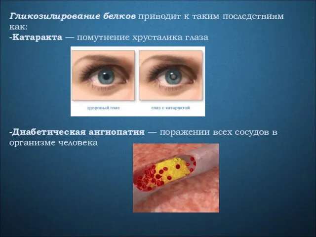 Гликозилирование белков приводит к таким последствиям как: -Катаракта — помутнение хрусталика