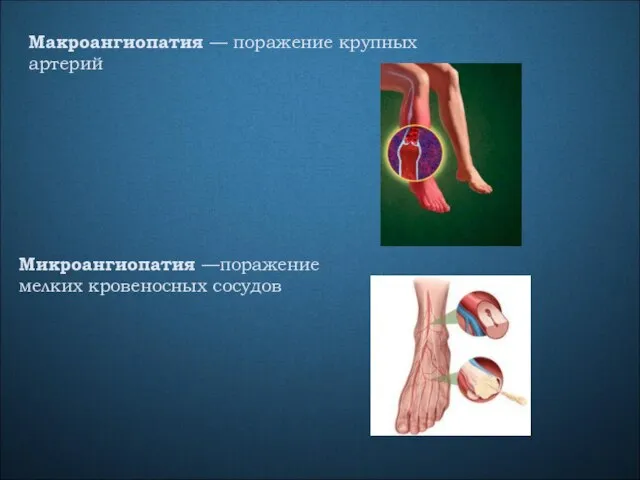 Макроангиопатия — поражение крупных артерий Микроангиопатия —поражение мелких кровеносных сосудов