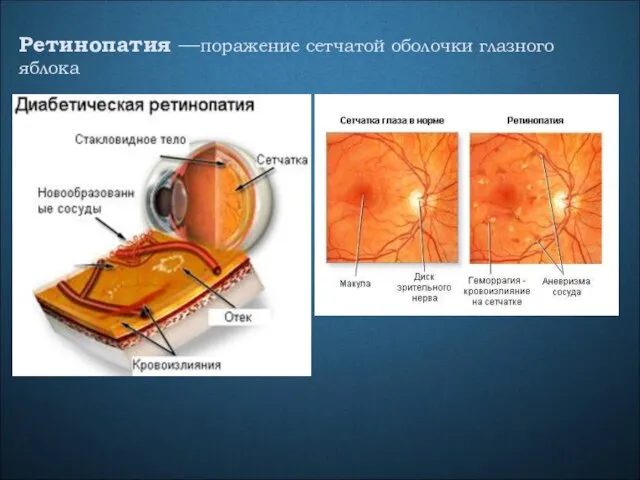 Ретинопатия —поражение сетчатой оболочки глазного яблока