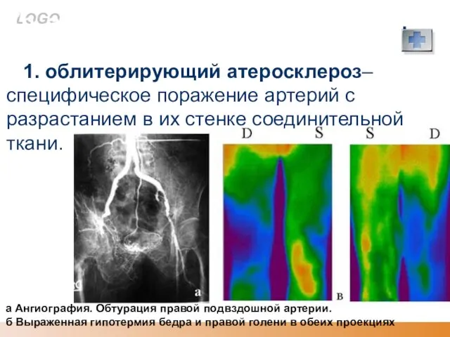 Хр. артериальная недостаточность. Причины: 1. облитерирующий атеросклероз–специфическое поражение артерий с разрастанием