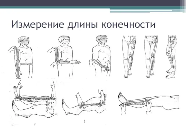 Измерение длины конечности