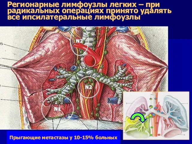 Регионарные лимфоузлы легких – при радикальных операциях принято удалять все ипсилатеральные