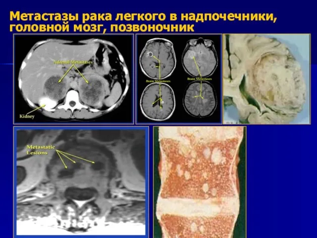 Метастазы рака легкого в надпочечники, головной мозг, позвоночник