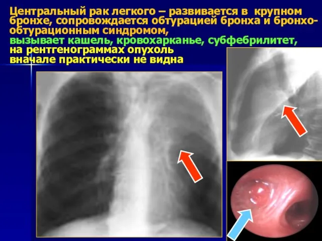 Центральный рак легкого – развивается в крупном бронхе, сопровождается обтурацией бронха