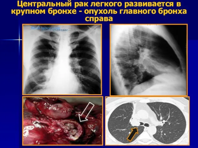 Центральный рак легкого развивается в крупном бронхе - опухоль главного бронха справа