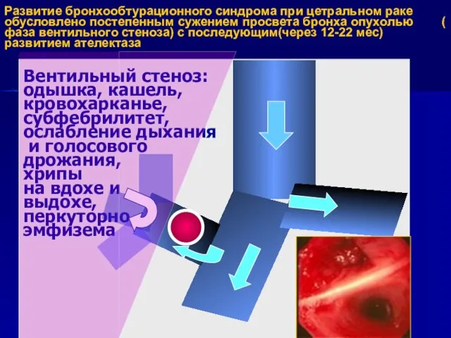 Развитие бронхообтурационного синдрома при цетральном раке обусловлено постепенным сужением просвета бронха