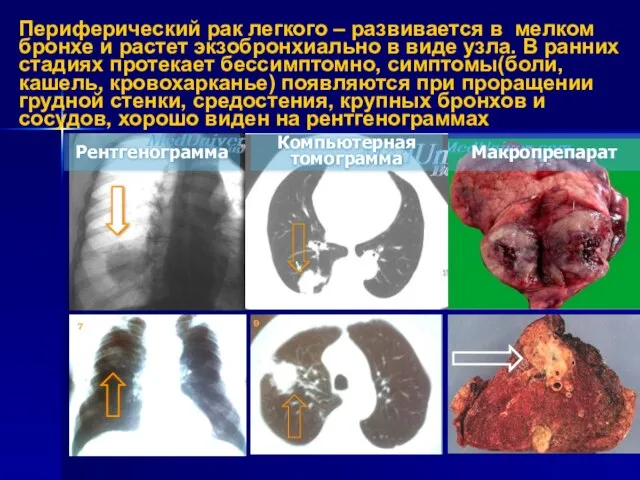 Периферический рак легкого – развивается в мелком бронхе и растет экзобронхиально