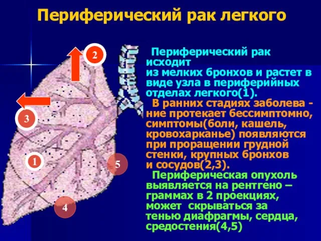 Периферический рак легкого 1 3 5 2 4 Периферический рак исходит