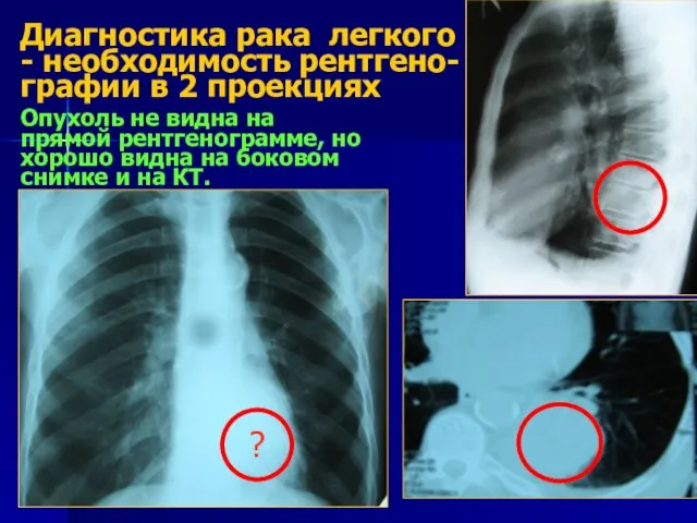 Диагностика рака легкого - необходимость рентгено-графии в 2 проекциях Опухоль не