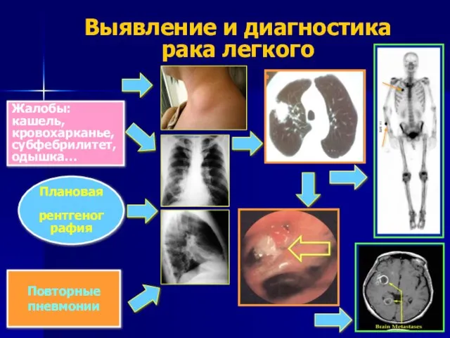 Выявление и диагностика рака легкого Жалобы: кашель, кровохарканье, субфебрилитет, одышка… Плановая рентгенография Повторные пневмонии