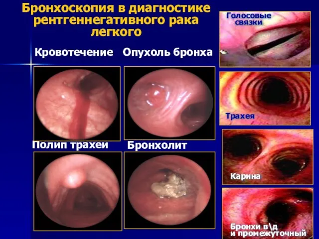 Бронхоскопия в диагностике рентгеннегативного рака легкого Кровотечение Опухоль бронха Полип трахеи