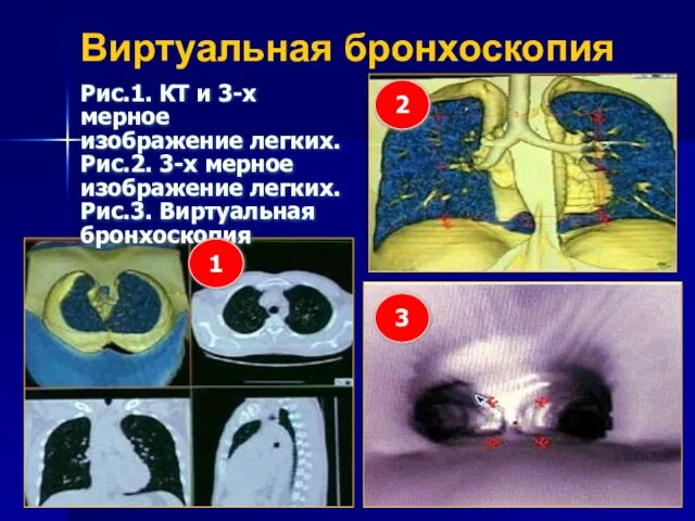 Виртуальная бронхоскопия Рис.1. КТ и 3-х мерное изображение легких. Рис.2. 3-х