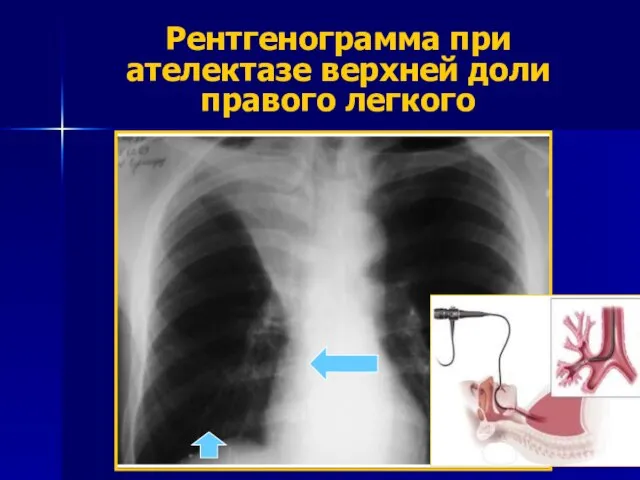 Рентгенограмма при ателектазе верхней доли правого легкого