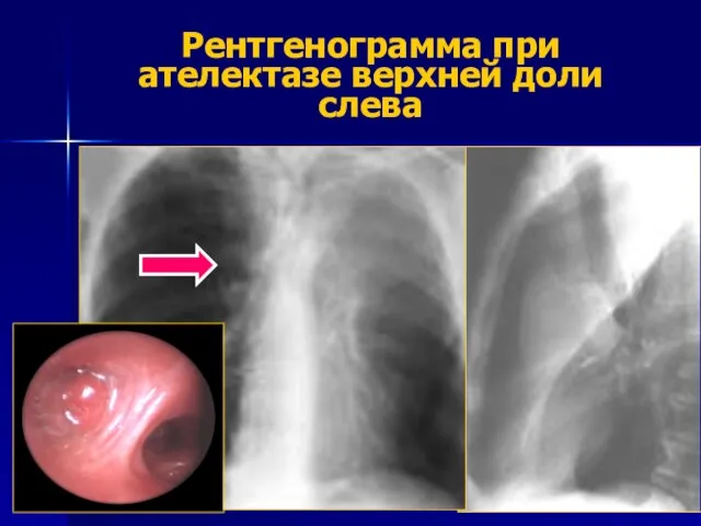 Рентгенограмма при ателектазе верхней доли слева