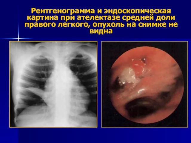 Рентгенограмма и эндоскопическая картина при ателектазе средней доли правого легкого, опухоль на снимке не видна