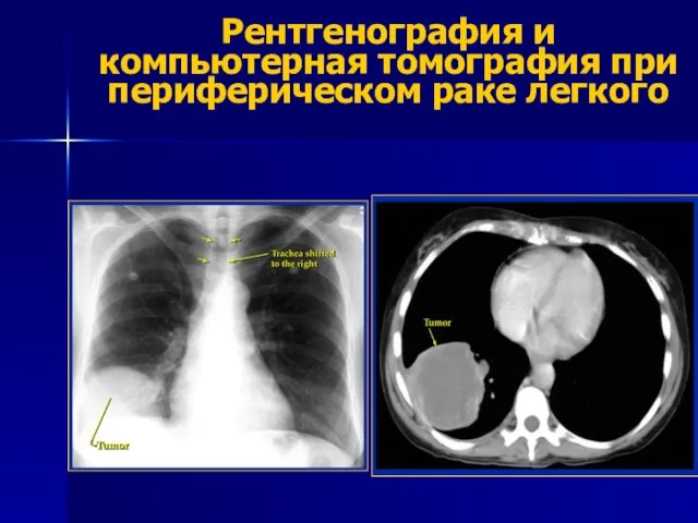 Рентгенография и компьютерная томография при периферическом раке легкого