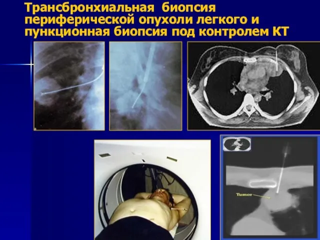 Трансбронхиальная биопсия периферической опухоли легкого и пункционная биопсия под контролем КТ