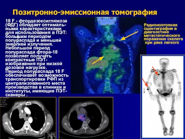 Позитронно-эмиссионная томография 18 F - фтордезоксиглюкоза (ФДГ) обладает оптималь-ными характеристиками для