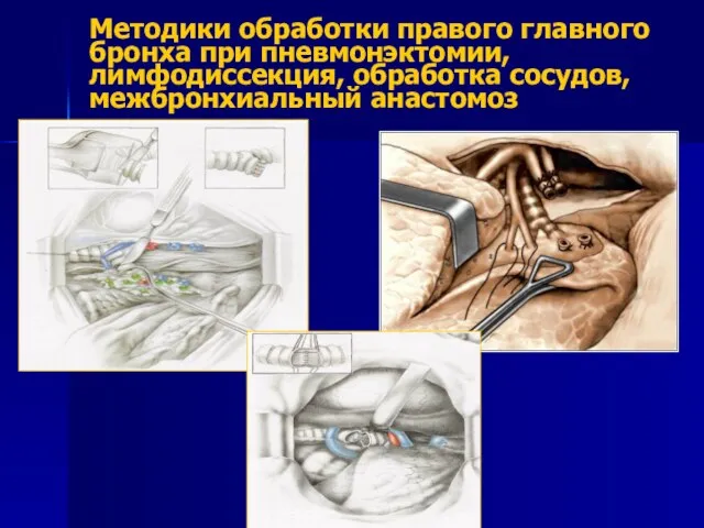 Методики обработки правого главного бронха при пневмонэктомии, лимфодиссекция, обработка сосудов, межбронхиальный анастомоз