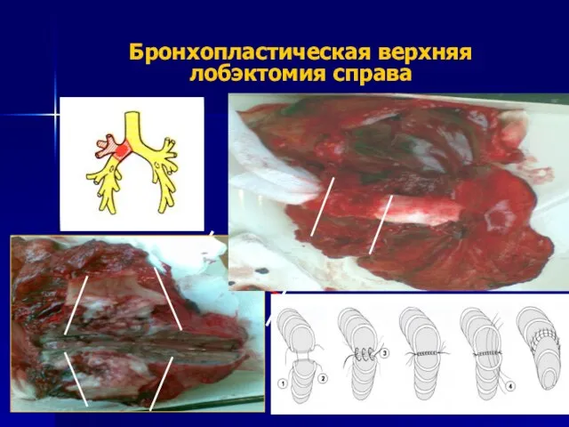 Бронхопластическая верхняя лобэктомия справа