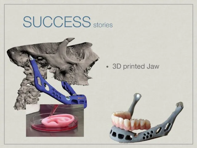 SUCCESS stories 3D printed Jaw