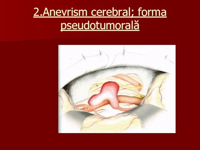 2.Anevrism cerebral; forma pseudotumorală