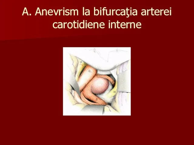 A. Anevrism la bifurcaţia arterei carotidiene interne