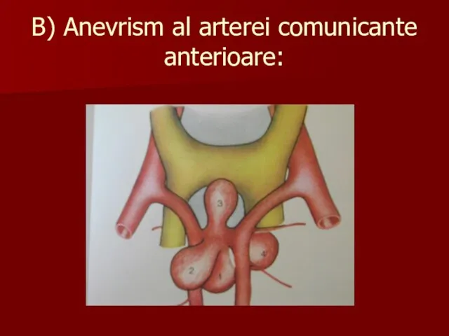 B) Anevrism al arterei comunicante anterioare: