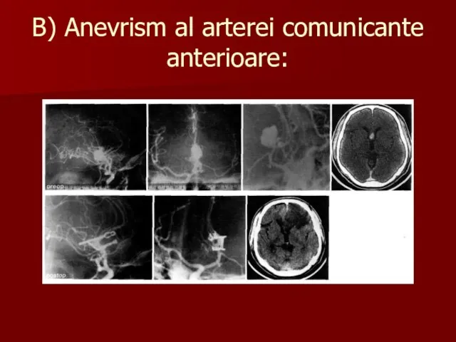 B) Anevrism al arterei comunicante anterioare: